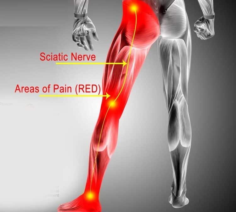 The Top 3 Essential Keys to Solving Sciatica with Chiropractic