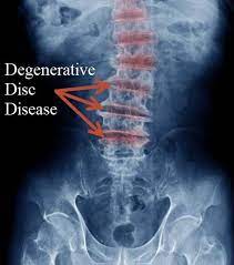 WHAT CAN CHIROPRACTIC DO FOR SPINAL ARTHRITIS, OSTEOARTHRITIS OR DEGENERATIVE JOINT DISEASE? OFTEN A WHOLE LOT MORE THAN THOSE DANGEROUS NON-STEROIDAL ANTI-INFLAMMATORIES!  