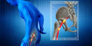  CAN A CHIROPRACTOR HELP WITH SCIATIC NERVE PAIN? YES, BUT DISCOVER WHY! WHERE TO FIND THE BEST GRASS VALLEY CHIROPRACTOR FOR SCIATICA.