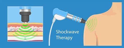 Healing with a Knock: Shockwave Therapy for Chiropractic Patients